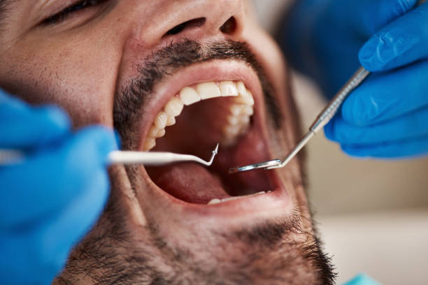 Best Emergency Tooth Extraction in Monroe, WI