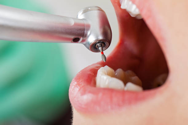 Best Emergency Tooth Extraction in Monroe, WI